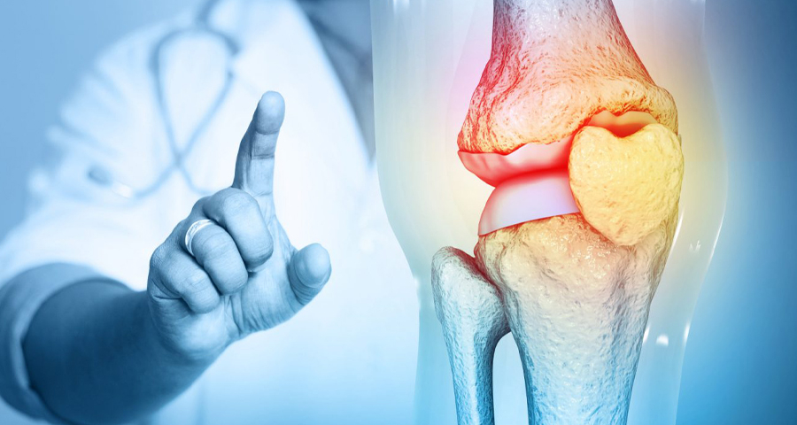 Kinematic Alignment vs. Mechanical Alignment in Total Knee Arthroplasty
